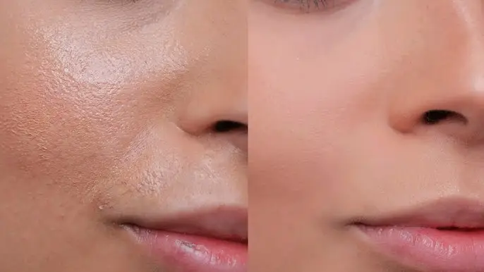 از بین بردن چربی صورت
